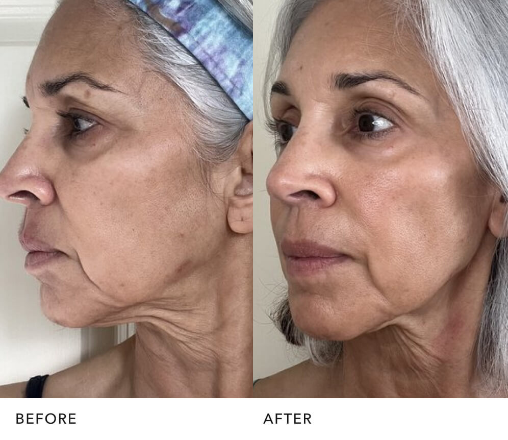  Before and after skin improvement with 手机168官网澳洲5™ essence: Brighter, Firmer, Smoother skin by SK-II USA