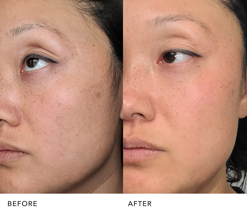  Before and after skin improvement with 手机168官网澳洲5™ essence: Radiant Looking Skin | SK-II USA