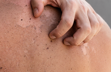 Possible Side Effects of Using Retinol and the Remedy 